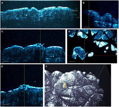 In vivo imaging of patients with chronic pruritus of unknown origin reveals partial sweat duct obstruction with partial itch resolution upon retinoid treatment